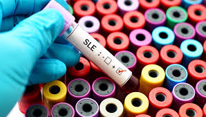 Tüm dünya koronavirüsle mücadele ederken virüsün en sert vurduğu hindistan'da yeni bir salgın paniği yaşanıyor. Kelebek Hastaligi Lupus Neden Olur Belirtileri Nelerdir Kelebek Hastaligi Nasil Tedavi Edilir Saglik Haberleri Ntv