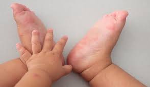 Some of the symptoms are rashes on hand and foot and sores in mouth. Hand Foot And Mouth Disease Symptoms Causes And Treatments