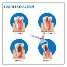 Image result for Tooth Extraction