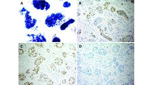 Hallmark of epithelioid mesothelioma is the epithelioid cells which are polygonal cells with moderate to abundant eosinophilic cytoplasm, vesicular round nuclei and prominent nucleolus; Cytology And Immunocytochemistry Of Pericardial Epithelioid Download Scientific Diagram