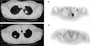 There has been extensive research on the utility of pet for sclc in terms of improved staging, restaging. The Role Of Positron Emission Tomography With 18f Fluoro 2 Deoxy D Glucose In Respiratory Oncology European Respiratory Society