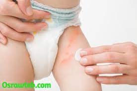 طفح الحفاضات دليلك الشامل عن الأسباب والعلاج أسرة وطب