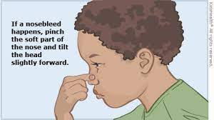 Picture Shows A Child With A Nosebleed Pinching The Nose And Leaning Forward Nose Bleeds Nose First Aid