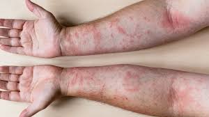 Image result for dermatitis contacta children