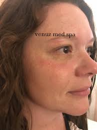 Venuz Med Spa Gallery — Venuz Med Spa
