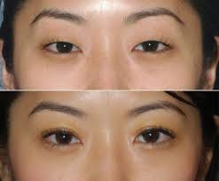 Saving Face More Asian Americans Opting For Plastic Surgery Hyphen Magazine Asian American Arts Culture And Polit Asian Eyes Plastic Surgery Eye Surgery
