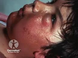 Image result for dermatitis contacta children
