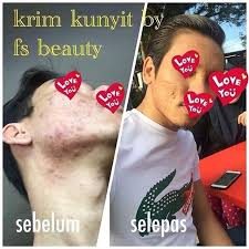Rm 29.90 (sm) / rm 31.90 (ss) khasiat : Krimkunyitoriginal Instagram Posts Gramho Com