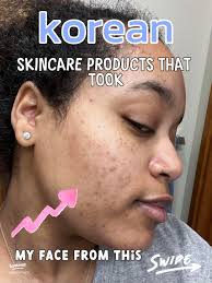 Effective Korean Skincare for Acne Scars: Key Ingredients and Product Tips