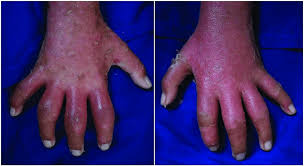 Image result for Dactylitis