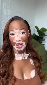 Image result for vitiligo model
