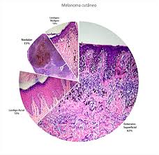The cancer usually develops in an ordinary mole that previously was benign (not cancerous), and it often remains in situ quite a while before penetrating deeper. Melanoma Clinical Evolutive And Histopathological Characteristics Of A Series Of 136 Cases Sciencedirect