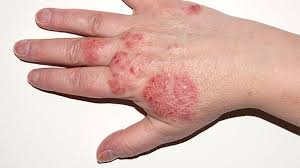 How to get rid of dark spots from eczema. Eczema Atopic Dermatitis Symptoms Treatment Causes More Everyday Health