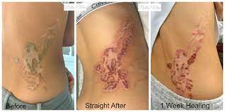 Ranging from dermabrasion, which literally sands away the unwanted pigmented skin, to using a salt mixture to heat up and scrape away your skin (salabrasion). 7 Salt And Saline Tattoo Removal Ideas Tattoo Removal Saline Tattoos
