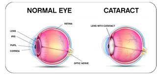 Your doctor might recommend this procedure if the phacoemulsification technique isn't a good option for you. Definition Of Cataract Thea