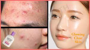 Helps in reducing acne reduce itching and redness. How To Get Rid Of Pimples Acne Skin Rashes Prickly Heat Overnight Lacto Calamine Benefits Youtube