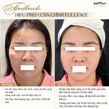 🆘 DA BODY CHÁY NẮNG, THÂM SẠM SAU HÈ PHẢI LÀM SAO? Sau những chuyến đi  biển phơi da, nhiều chị em than với Selflux vì làn da body bị: ❌ Cháy