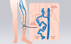 International Vascular Awareness Month | Vein Health Clinic Melbourne