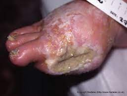 Infected Wounds, Causes, Symptoms And Treatment | Woundsource