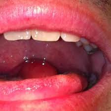 Image result for Uvulitis