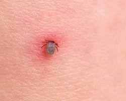 Imagem de carrapato transmitindo a bactéria da Doença de Lyme