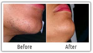 The average cost of laser hair removal is $429. Rmos Rmos Consultancy Rmos Gurgaon Rmos Contact Rmos Feedback Rmos Pvt Ltd Rmos India Rmos Hair Removal Systems Remove Unwanted Facial Hair Hair Removal