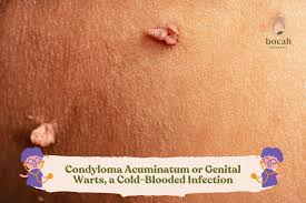 Image result for genital warts
