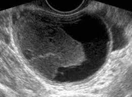 Image result for corpus luteum sonography)
