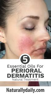 5 Best Essential Oils For Perioral Dermatitis Remedies Perioral Dermatitis Is A Common Inf Perioral Dermatitis Perioral Dermatitis Remedies Dermatitis Remedies