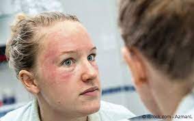 There are so many signs and symptoms that rosacea has four subtypes. Rosacea Ursachen Symptome Behandlung Meine Gesundheit