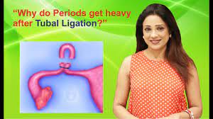 Tubal Ligation Should Be Done On Which Day Of Menstrual Cycle Youtube