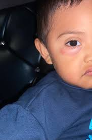 Hey all! My daughter got bite by a mosquito