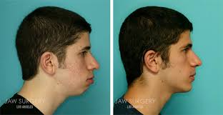During the procedure, an oral surgeon moves the lower jawbone forward or backward, depending on the patient's bite alignment. Before After Photos Los Angeles Ca Jaw Surgery La