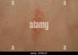 Image result for Eczema nummulare
