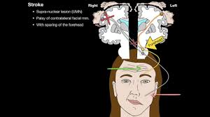 Instead, your doctor will analyze your treating bell's palsy is vastly different from treating a stroke, and most people with it will experience a full recovery. Bells Palsy And Stroke Youtube