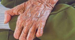 Leprosy Vs Psoriasis What S The Difference