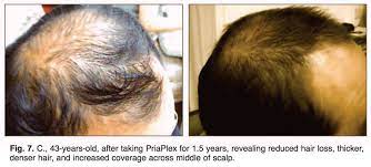 Concerns about dhea causing hair loss in men has led to the development of a metabolite of dhea known as 7 keto dhea. Reversing Age Related Hair Loss And Restoring Healthy Hair Growth In Men And Women Nutrition Review