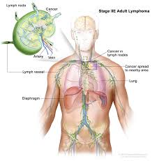 Usually lymph nodes are not visible. Hodgkin Lymphoma Hematology Oncology Associates Of Cny
