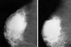 It presents as a persistent, dominant, palpable, hypersencible tumor with a smooth cystic consistency