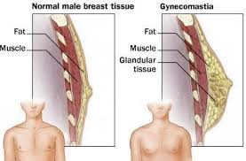 You'll normally need to pay privately for breast reduction surgery in these cases. Safe Treatment For Gynecomastia Male Breast Reduction In Thailand