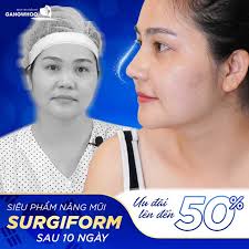 Nâng Mũi Dáng Trung Hoa