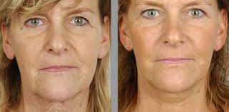 Implnat mammaire tunisie prix , prix correction ptose mammaire , prix chirurgie esthetique nez tunisie. Lifting Visage Tunisie Prix Lifting Facial Pas Cher