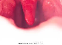 Image result for Uvulitis