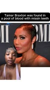 What Happened to Tamara Judge Teeth