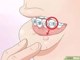 There are a number of different home remedies to be explored, and we will. How To Make Your Braces Hurt Less With Pictures Wikihow