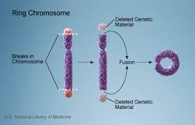 Ring Chromosome 14 Syndrome Medlineplus Genetics