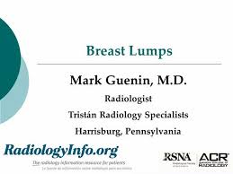 Family history of breast cancer. Breast Lumps Diagnosis Evaluation And Treatment