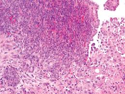 Check spelling or type a new query. Challenges And Controversies In The Diagnosis Of Malignant Mesothelioma Part 2 Malignant Mesothelioma Subtypes Pleural Synovial Sarcoma Molecular And Prognostic Aspects Of Mesothelioma Bap1 Aquaporin 1 And Microrna Journal Of Clinical Pathology