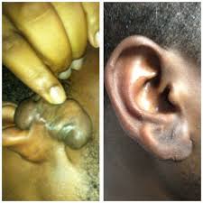 Image result for Keloid
