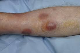 Image result for Panniculitis